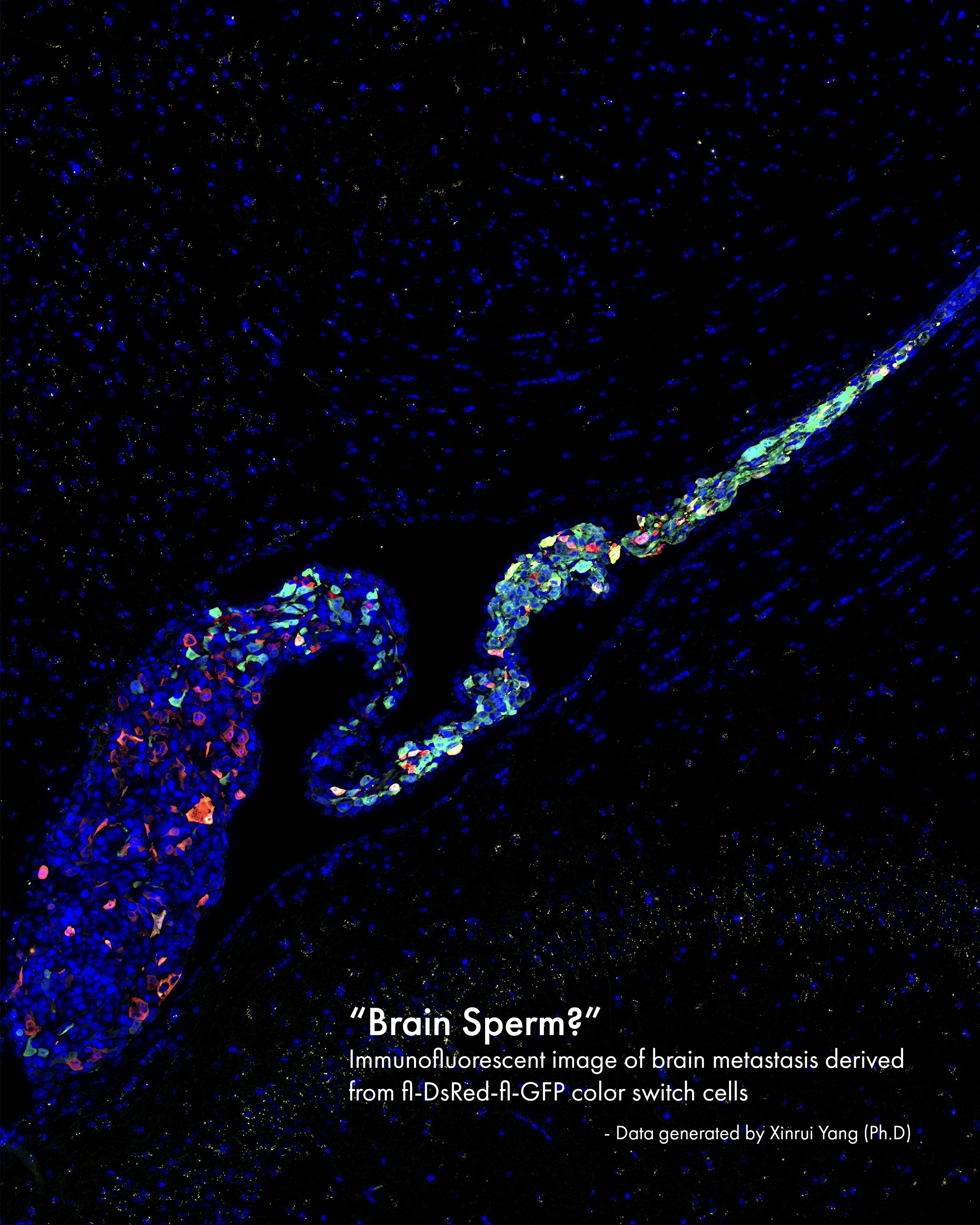 The Brain Metastasis 'Sperm'